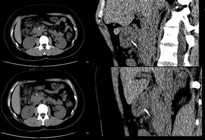 An ingested metallic wire migrating from stomach to pancreas treated by laparoscopic surgery: A case report